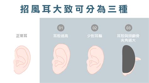 耳朵沒有輪廓|招風耳手術